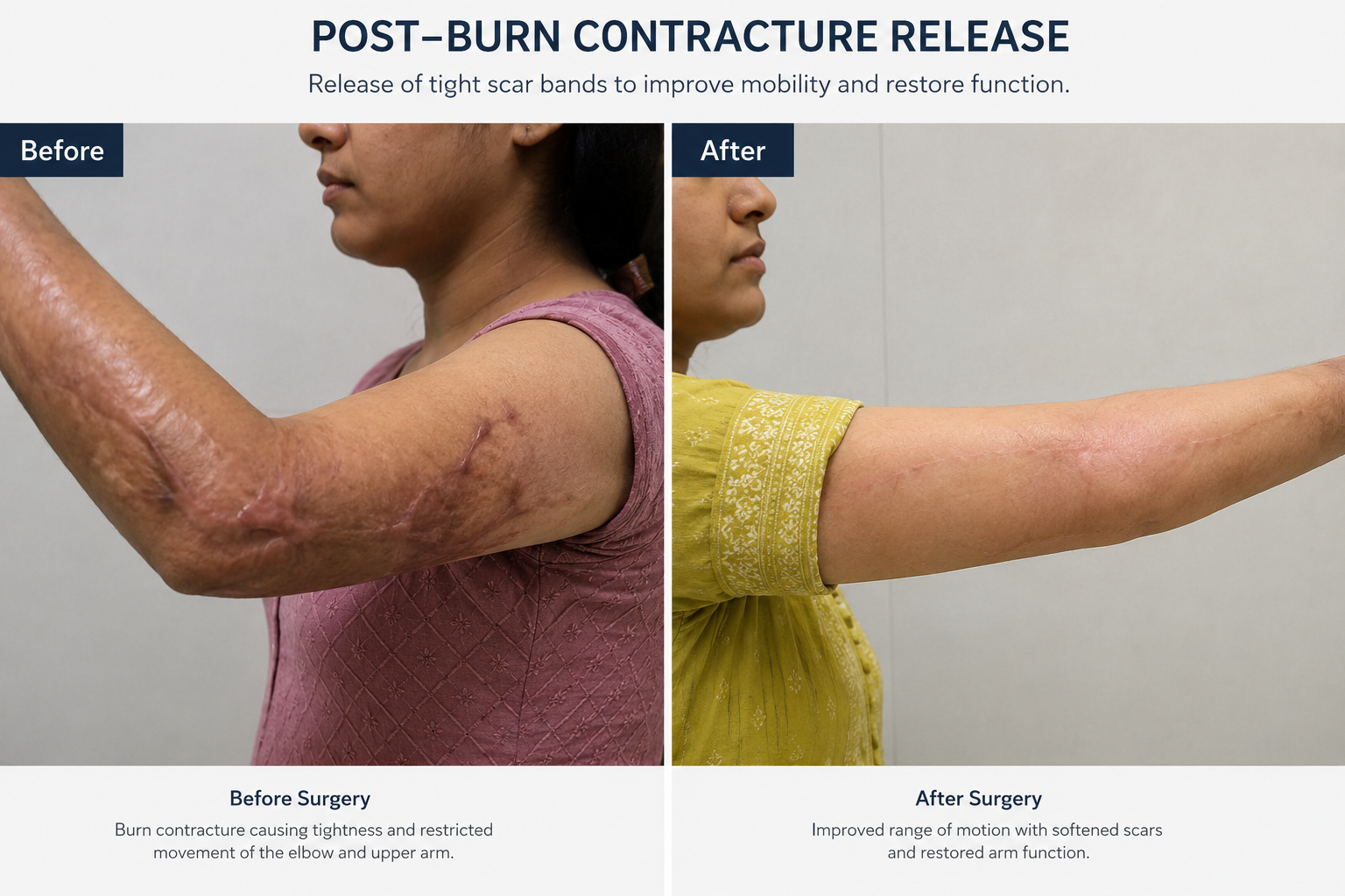 Burn Reconstruction Case 1